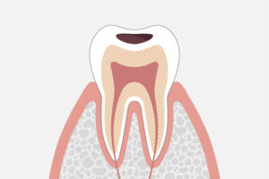 象牙質にまで達した虫歯