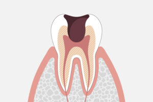 歯髄に達した状態の虫歯
