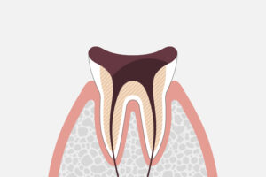 歯髄に達した状態の虫歯2